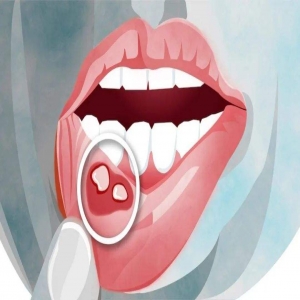 常年反复口腔溃疡是什么原因？3种方法让你早日摆脱折磨